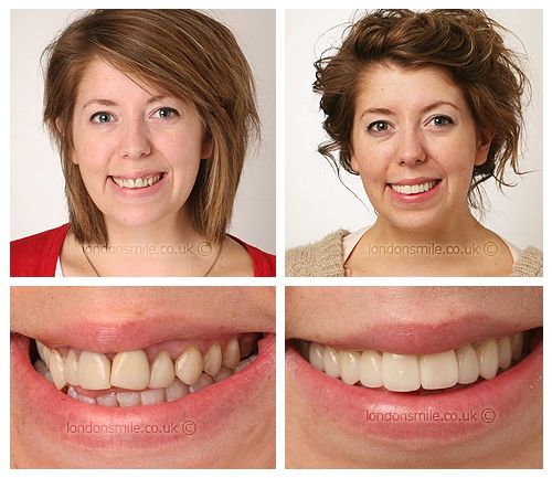 Laser Gum Reshaping & Gum Lift London Gummy Smile Treatment - The London  Smile Clinic W1