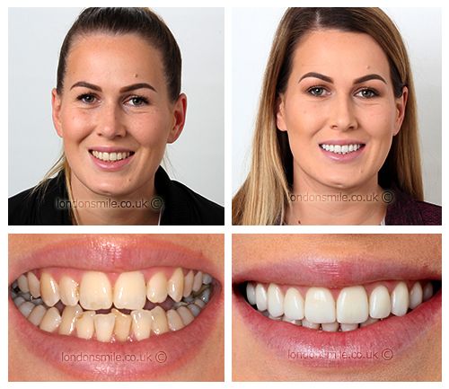 Six Months Fixed Braces, Gum Contouring and Dental Veneers - Replacement of  Old Teeth Veneers - London Smile