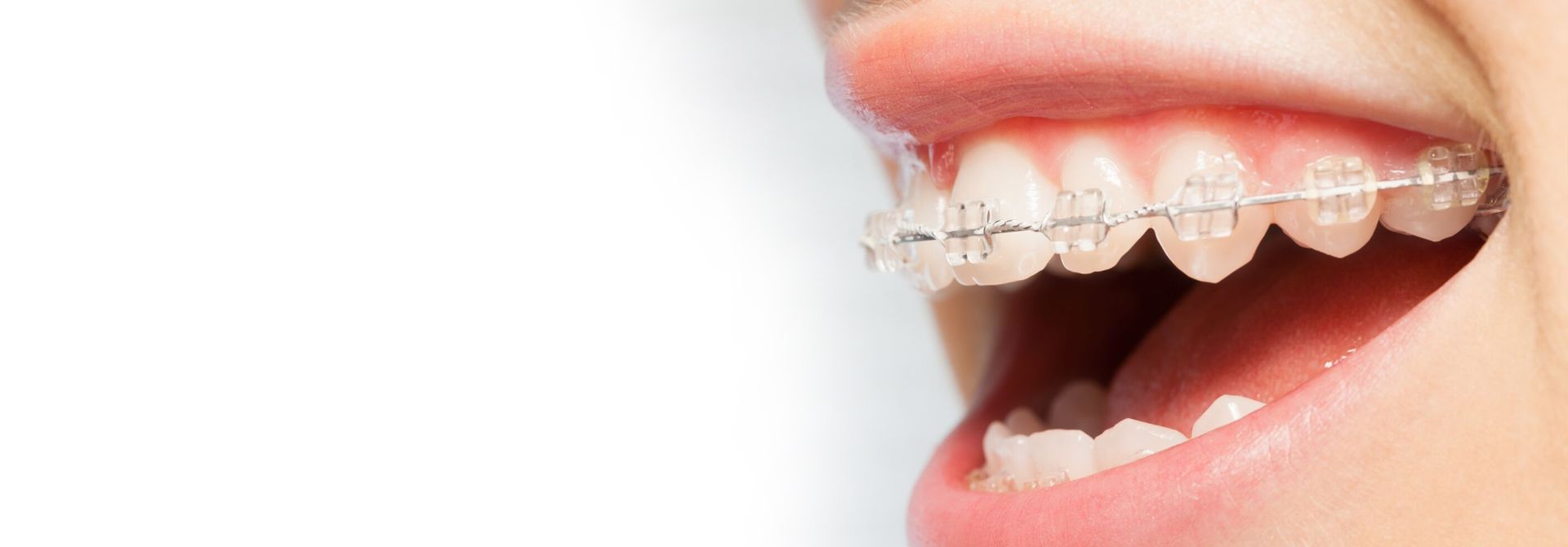 Tooth Coloured Ceramic Braces & Clear Braces London W1 - The London Smile  Clinic